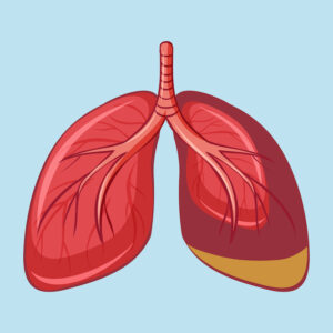 CVE Human Lung with Pleural Mesothelioma